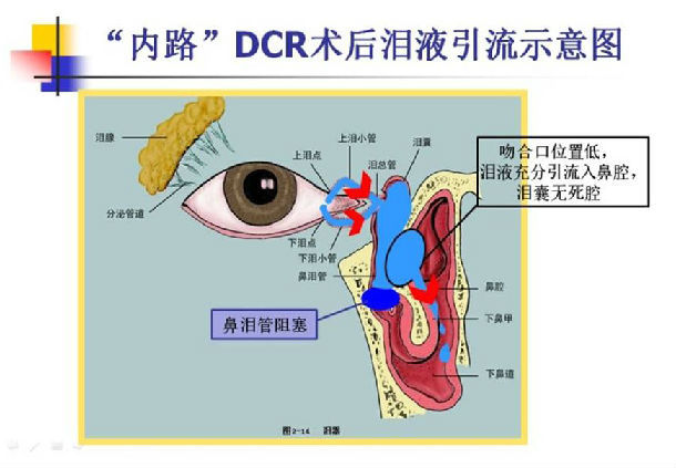 泪囊鼻腔吻合手术的"内路"和"外路"