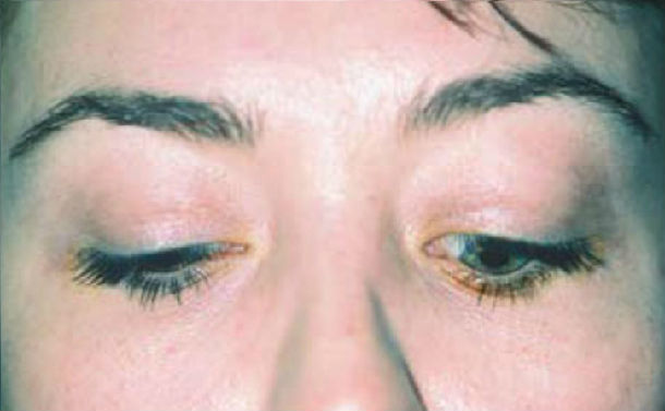 甲状腺相关眼病(俗称甲亢突眼)是成人最常见的突眼病因.