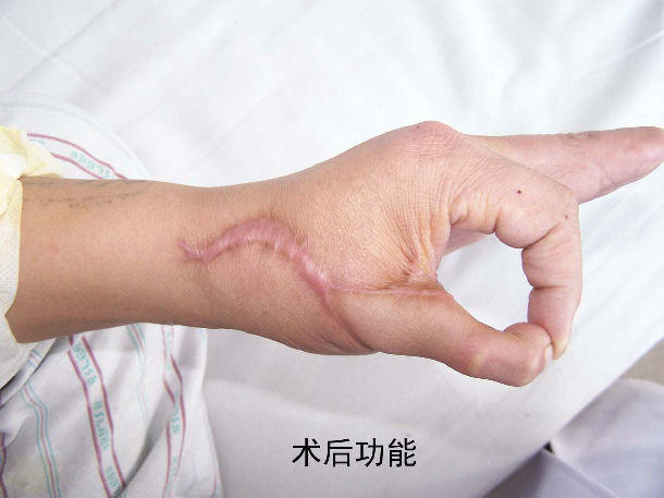 第2足趾游离移植再造拇指术