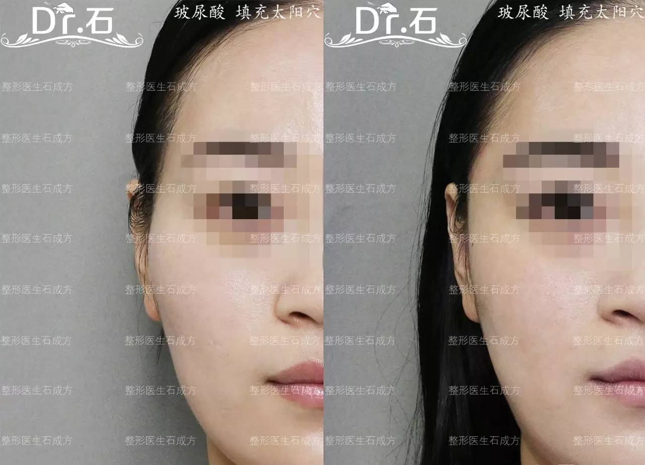 打造心形脸步骤之一就是通过玻尿酸填充颞部,印堂和眉弓,让脸的上半