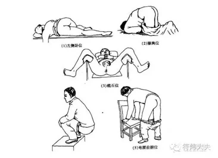 直肠指检是一种怎样的体验?