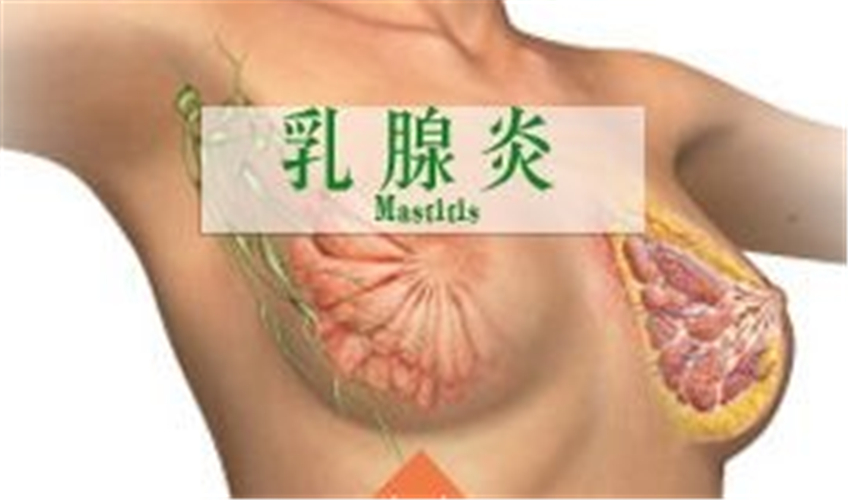 乳腺炎图片