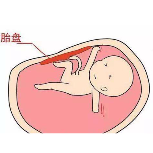 怀孕期间是如何胎盘早剥