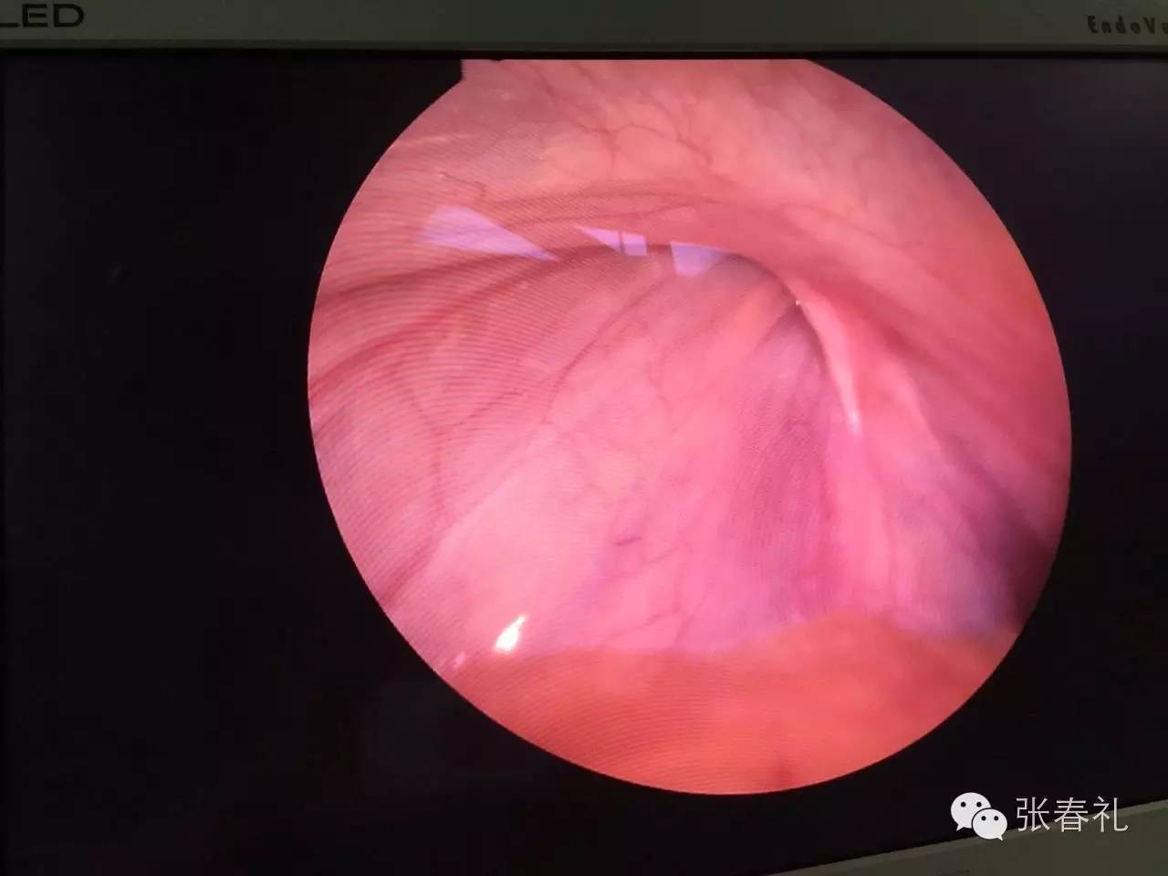 一文了解:小儿腹股沟疝腹腔镜手术知识_张春礼