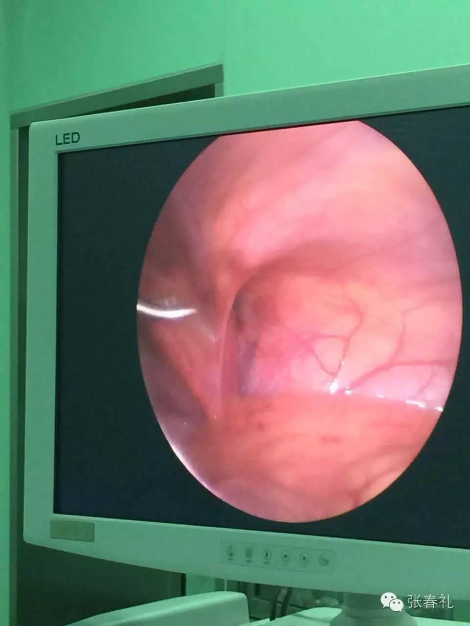 一文了解:小儿腹股沟疝腹腔镜手术知识_张春礼