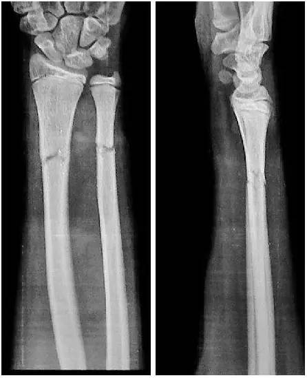 骨折复位到什么程度才算是满意?_刘东昕