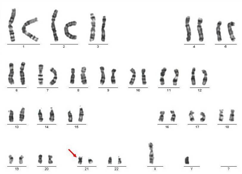 患儿体内存在两种细胞系,一为正常细胞,一为21—三体细胞,形成嵌合体