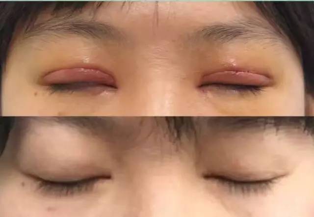 切开双眼皮术后的疤痕很明显吗?