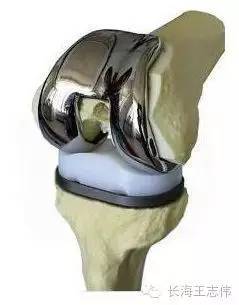 科普——膝关节表面置换手术