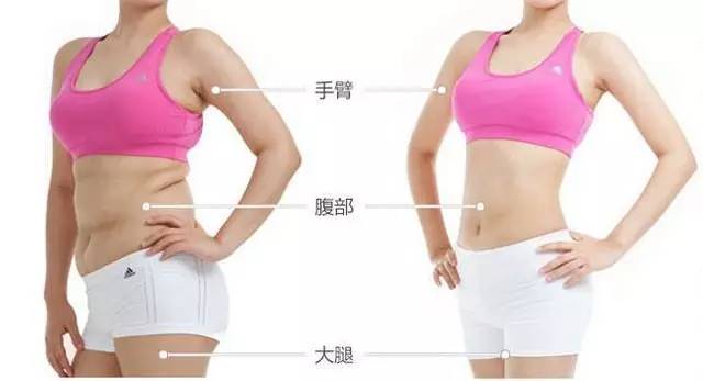 吸脂减肥注意事项需知!