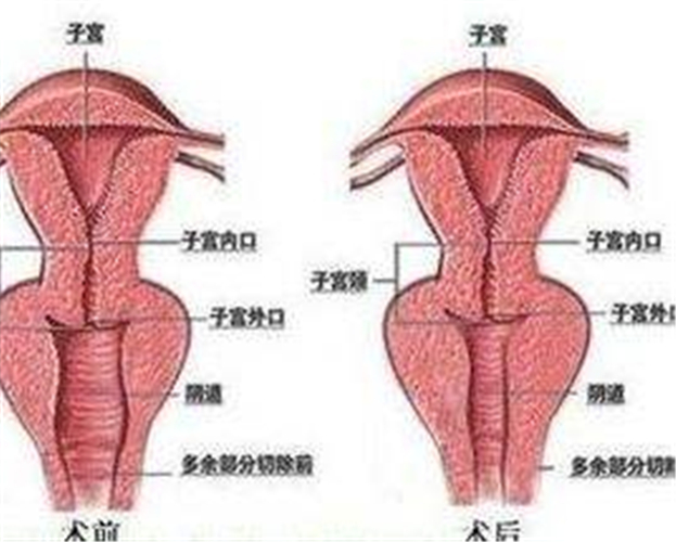 縮小陰道口手術效果圖片