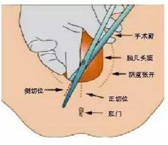 陰道口側(cè)切圖片