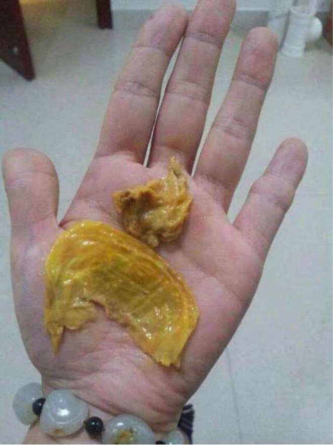 中度子宮糜爛圖片