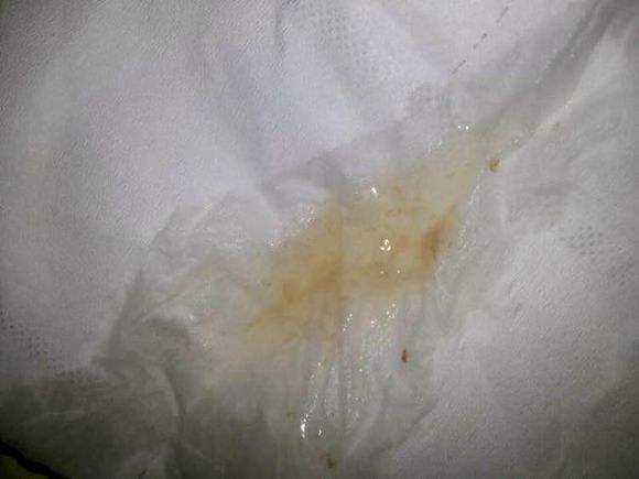 子宮糜爛白帶的圖片