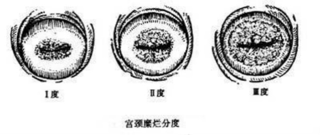 子宮糜爛3度嚴重嗎圖片