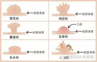 肛门,直肠,阴道及宫颈损害有疼痛,性交痛及接触性出血,阴道,宫颈损害