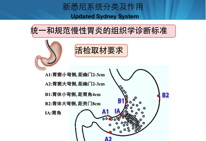 慢性胃炎的分级标准介绍