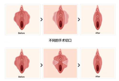 陰唇肥大的圖樣