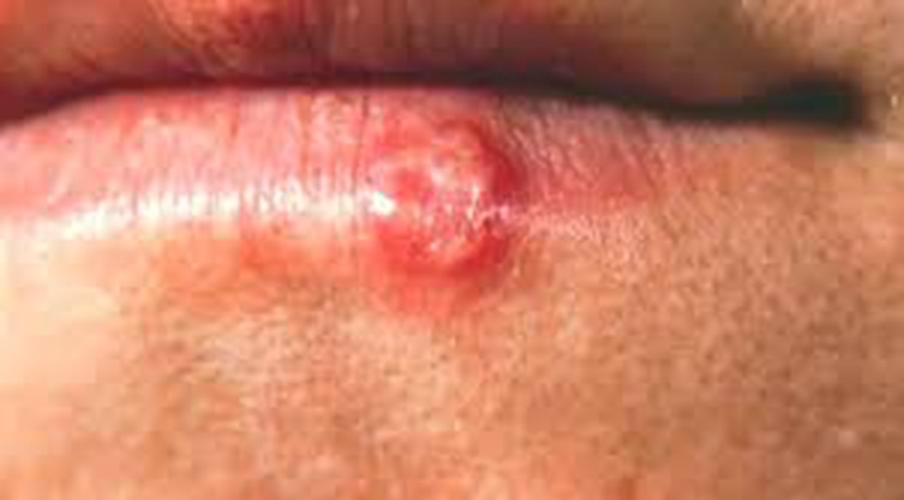 艾滋病初期嘴唇上症状图片