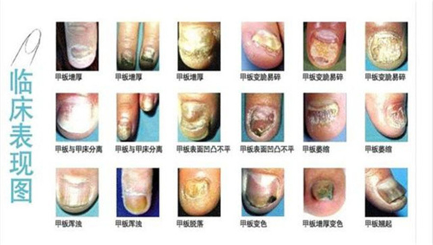 灰指甲臨床表現