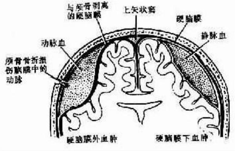 慢性硬脑膜外血肿