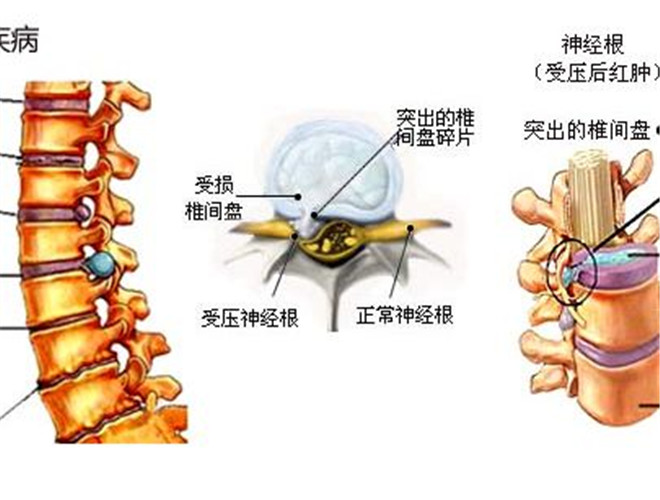 看腰間盤突出哪里好