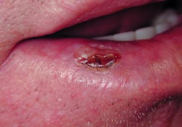 唇癌早期症状