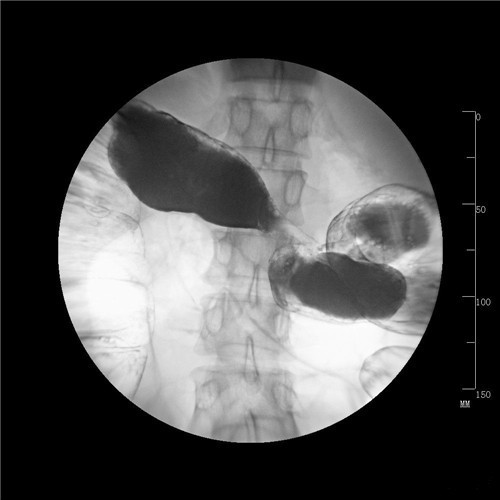 潰瘍性結(jié)腸炎鋇餐檢查圖片