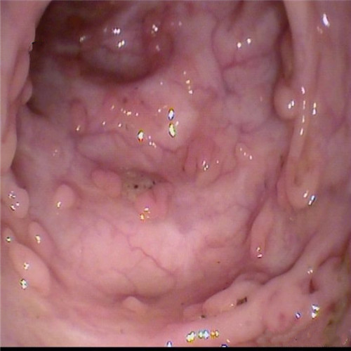 潰瘍性結(jié)腸炎底壁直觀圖片