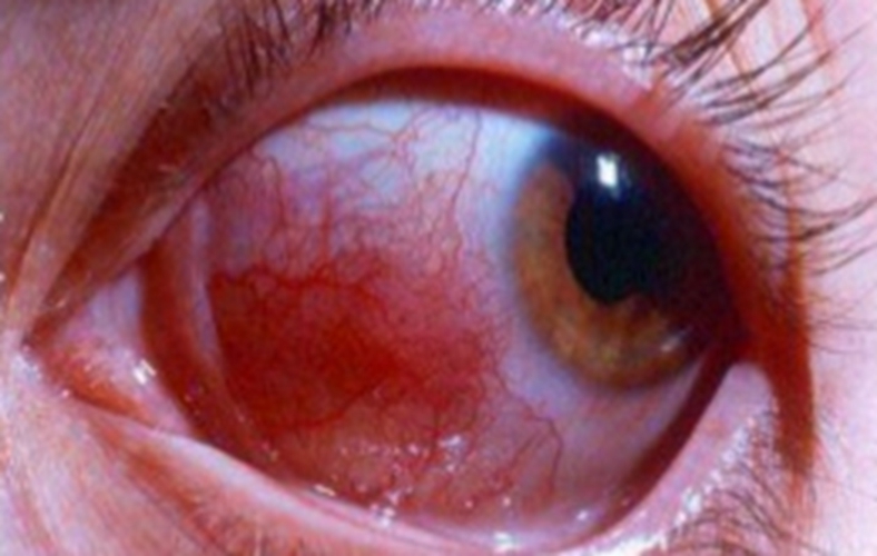 病毒性结膜炎的结膜的充血图片