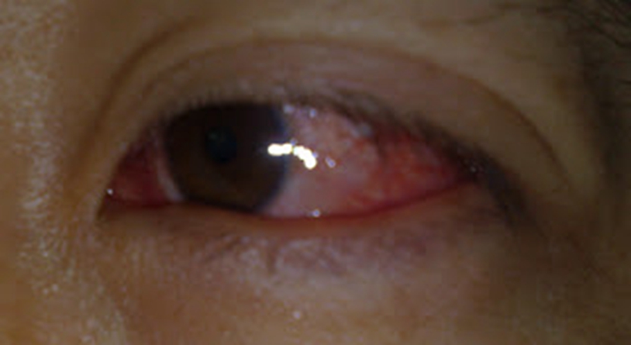 眼睛的急性传的染性结膜炎症状图片