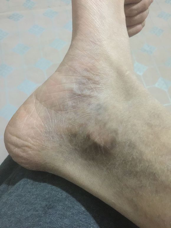 男性腳踝靜脈炎圖片