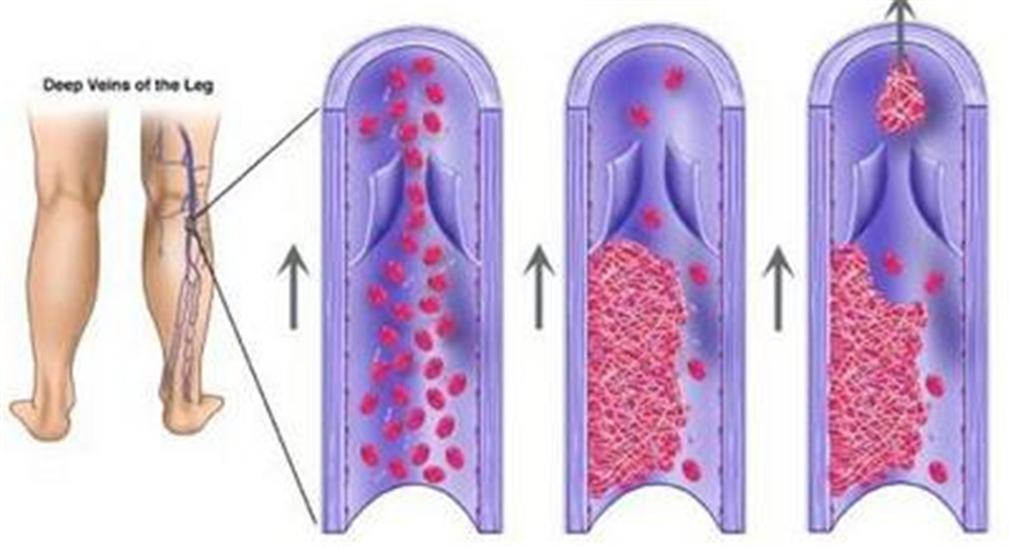 血栓性靜脈炎圖片