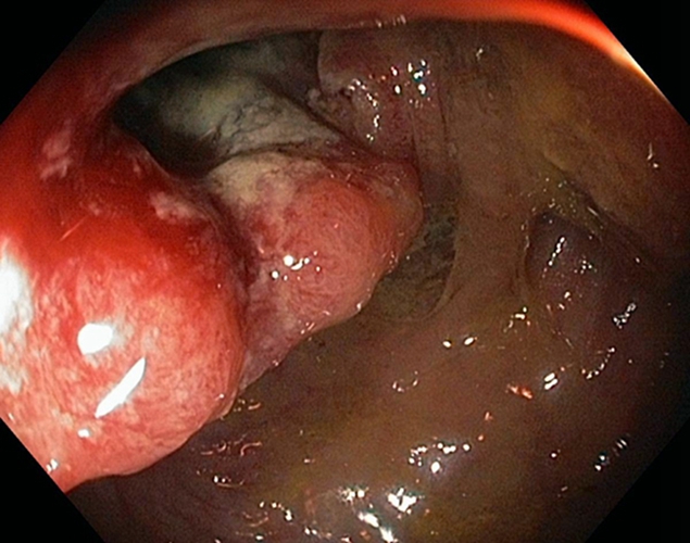  乙狀結(jié)腸癌癥腺癌二級(jí)狀圖片