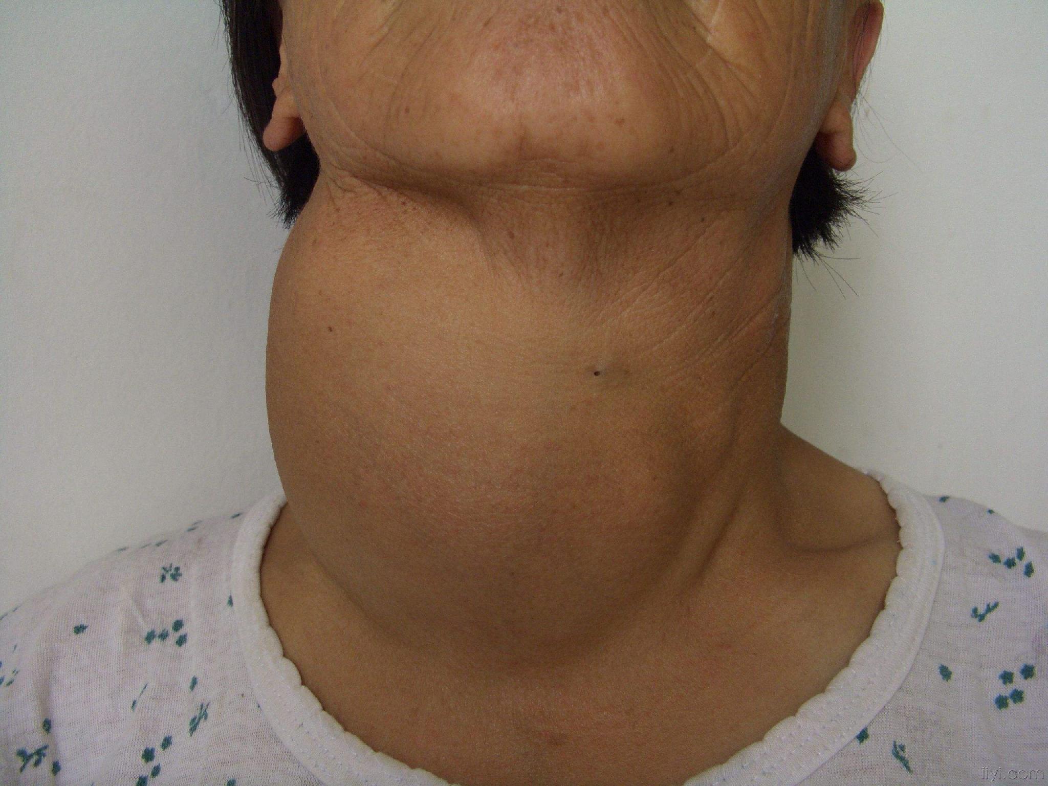 早期颈部淋巴癌图片-图库-五毛网