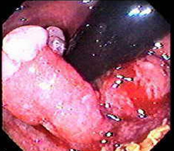 右半结肠癌腺癌二级常见临床 特点 图片