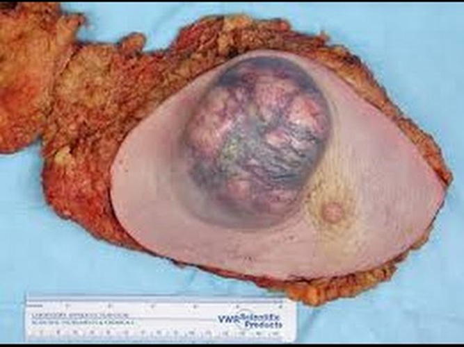 右半结肠癌腺癌图片