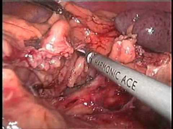 右半结肠癌粘液腺癌常见 临床特点 图片