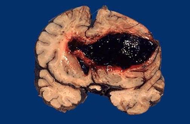 脑出血图片