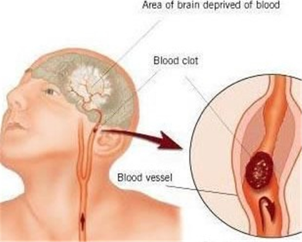 腦血栓解說圖片