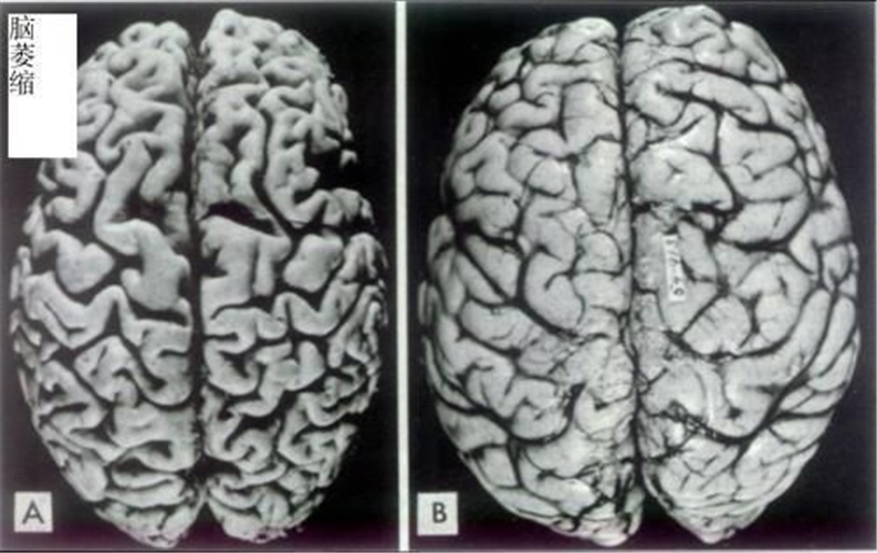 先天性脑萎缩与正常大脑对比图片