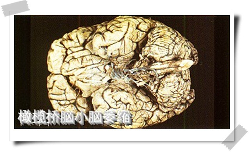 橄榄桥脑小脑脑萎缩图片