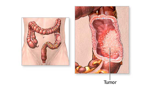 预防结肠癌需漫画