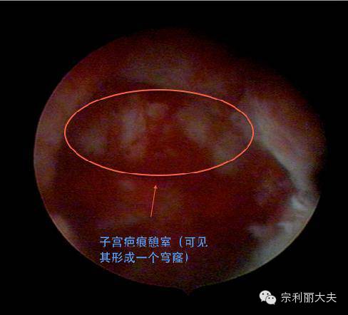 谈一谈剖宫产术后子宫疤痕憩室