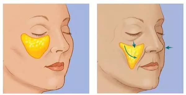 泪沟是怎么形成的?