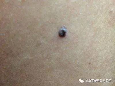 痣有哪些分类?点痣该选择哪一种手术治疗?