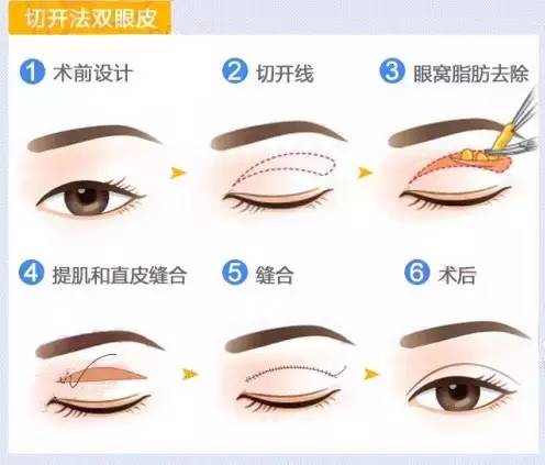 切开法双眼皮手术过程