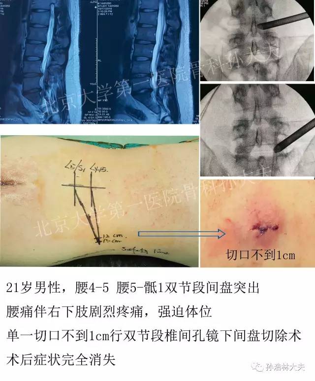 腰椎间盘突出症是否可以微创手术?