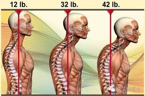 2,肌肉疲劳造成姿态改变如图所示:颈椎生理曲度向前凸,胸椎生理曲度向