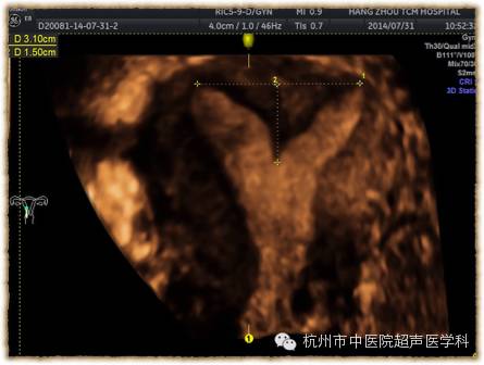 子宫畸形的超声诊断